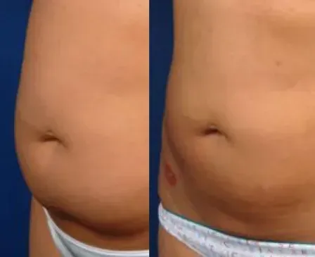 Before and after, abdomen side view