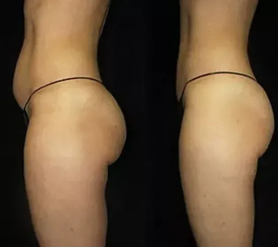 Before and after, body profile