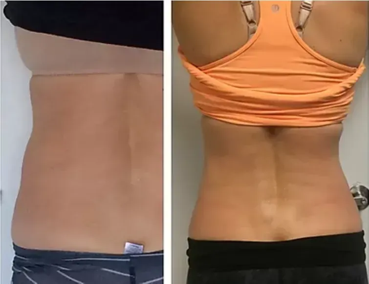 Before and after, lower back