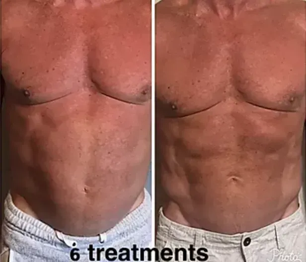 Before and after, male torso, 6 Contour Light treatments