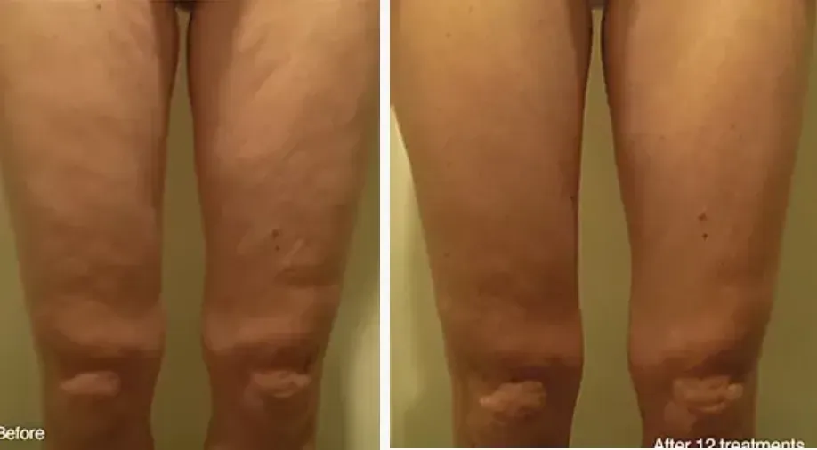 Before and after, thighs and cellulite, 12 treatments