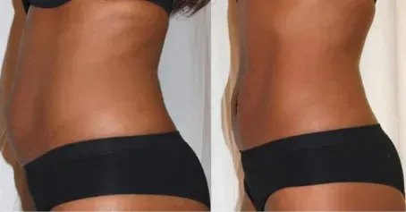 Before and after, waistline