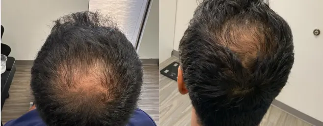 Before and after PRP hair restoration of a patient’s crown at Waters Edge Medical Clinic, St. Petersburg