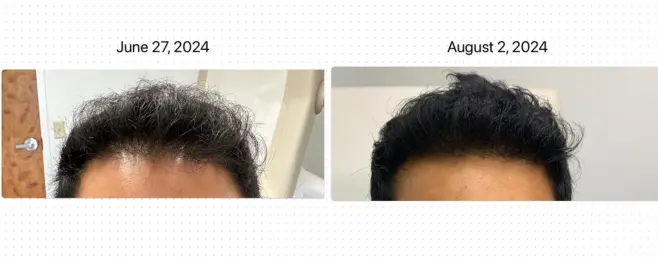 Before and after PRP hair restoration of a patient’s frontal hairline at Waters Edge Medical Clinic, St. Petersburg